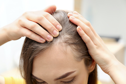 Jeune femme perd ses cheveux